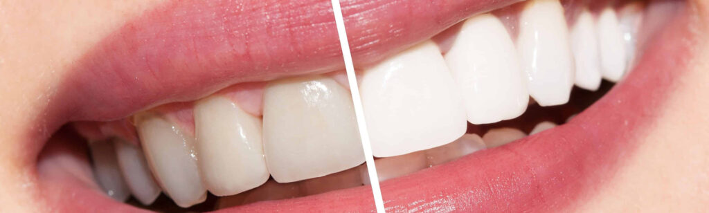 Teeth Whitening